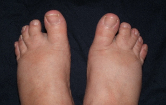 Amy's webbed toes