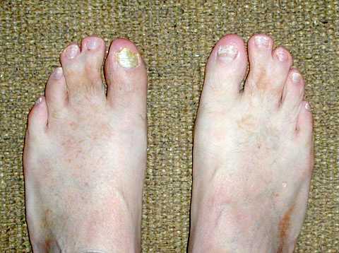 World Wide Webbed Toes